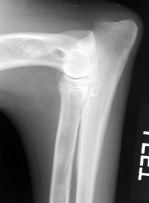 Radiograph of the Lateral Left Elbow