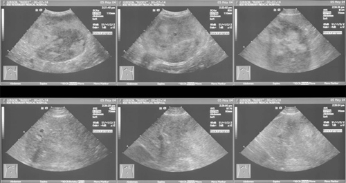 Fig. 5 Ultrasound Images of Hepatic Mass