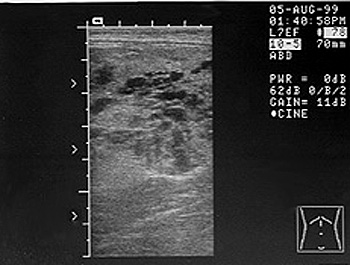 Ultrasonographic image of the liver