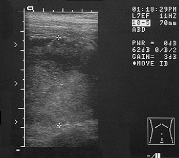 Ultrasound image of sublumbar lymphnodes
