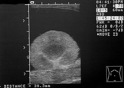 Ultrasonographic image of the right kidney