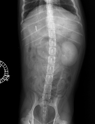 Radiograph of the Intravenous pyelogram - nephrogenic phase - ventrodorsal view