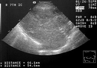 Ultrasound image of lung