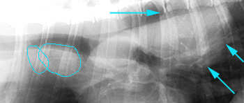 Radiograph showing deviation of the mainstem bronchi