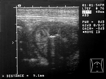 Ultrasonographic image of the intestine