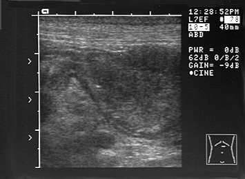 Ultrasonographic image of the intestine