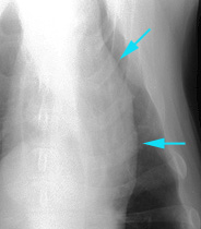 Radiograph of the Cranial mediastinal mass effect most likely associated with sternal lymphadenopathy