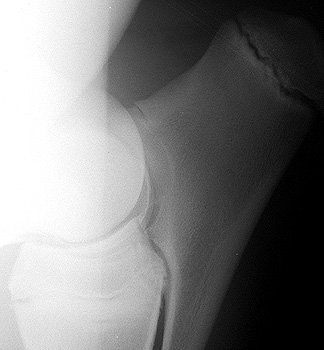 Radiograph of the Right Lateral View - Right Elbow (Enlarged)