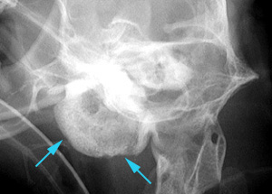 Radiograph showing severe thickening with irregular new bone of left tympanic bulla