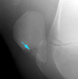Radiograph of the Lateral View of Left Patella